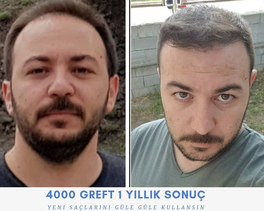 4000 GREFT 1 YLLIK SONUÇ