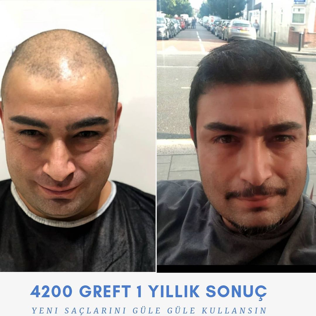 4200 GREFT 1 YLLIK SONUÇ