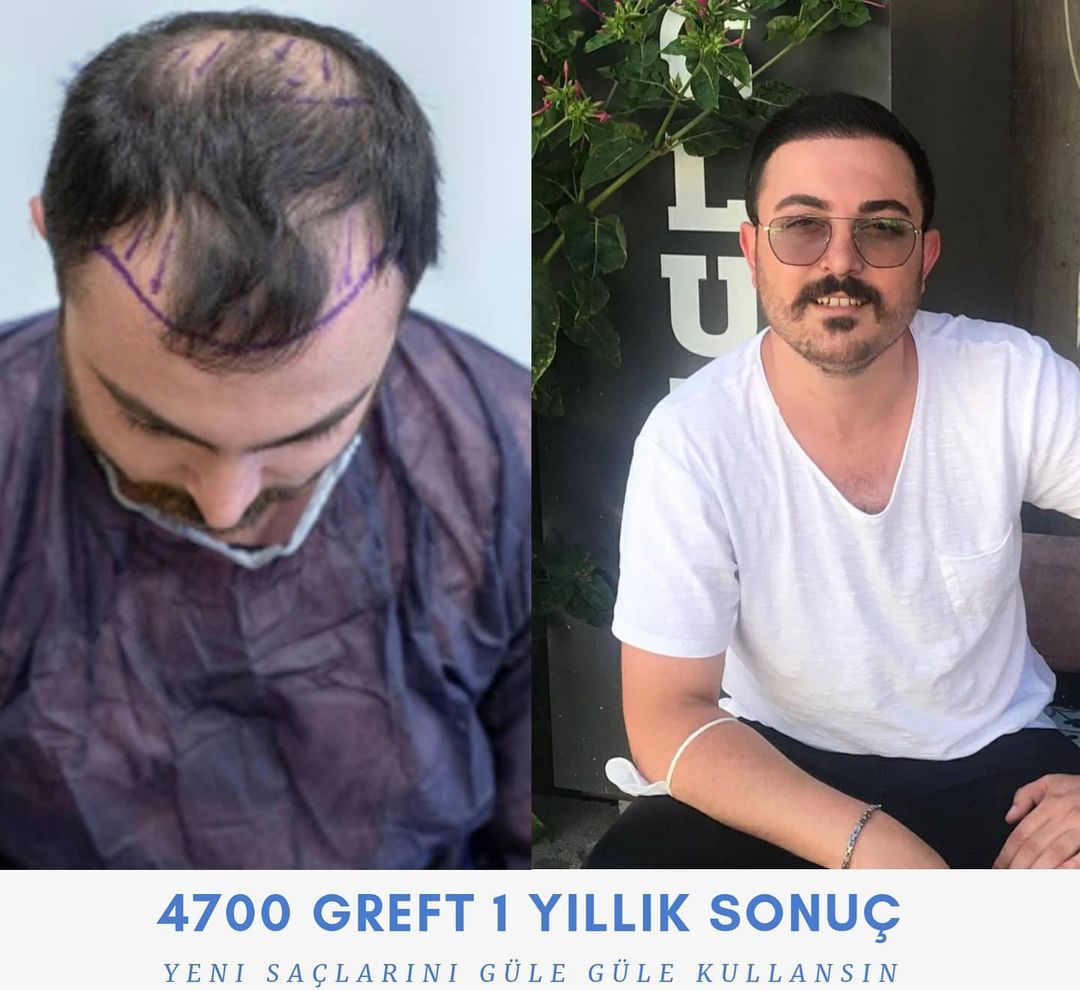 4700 GREFT 1 YLLIK SONUÇ