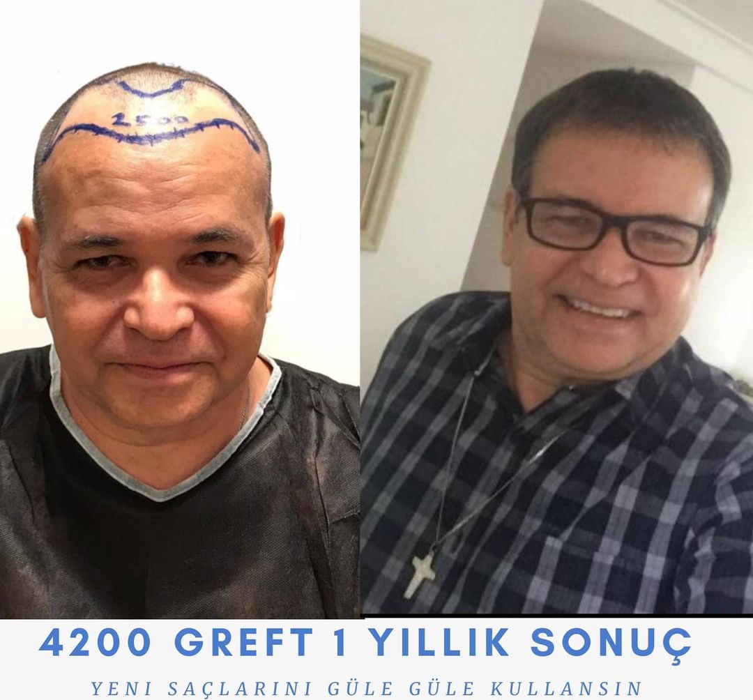 4200 GREFT 1 YLLIK SONUÇ