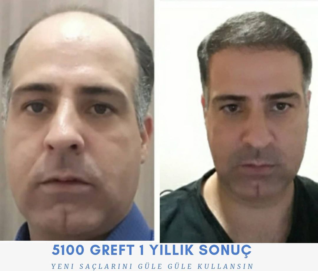 5100 GREFT 1 YLLIK SONUÇ