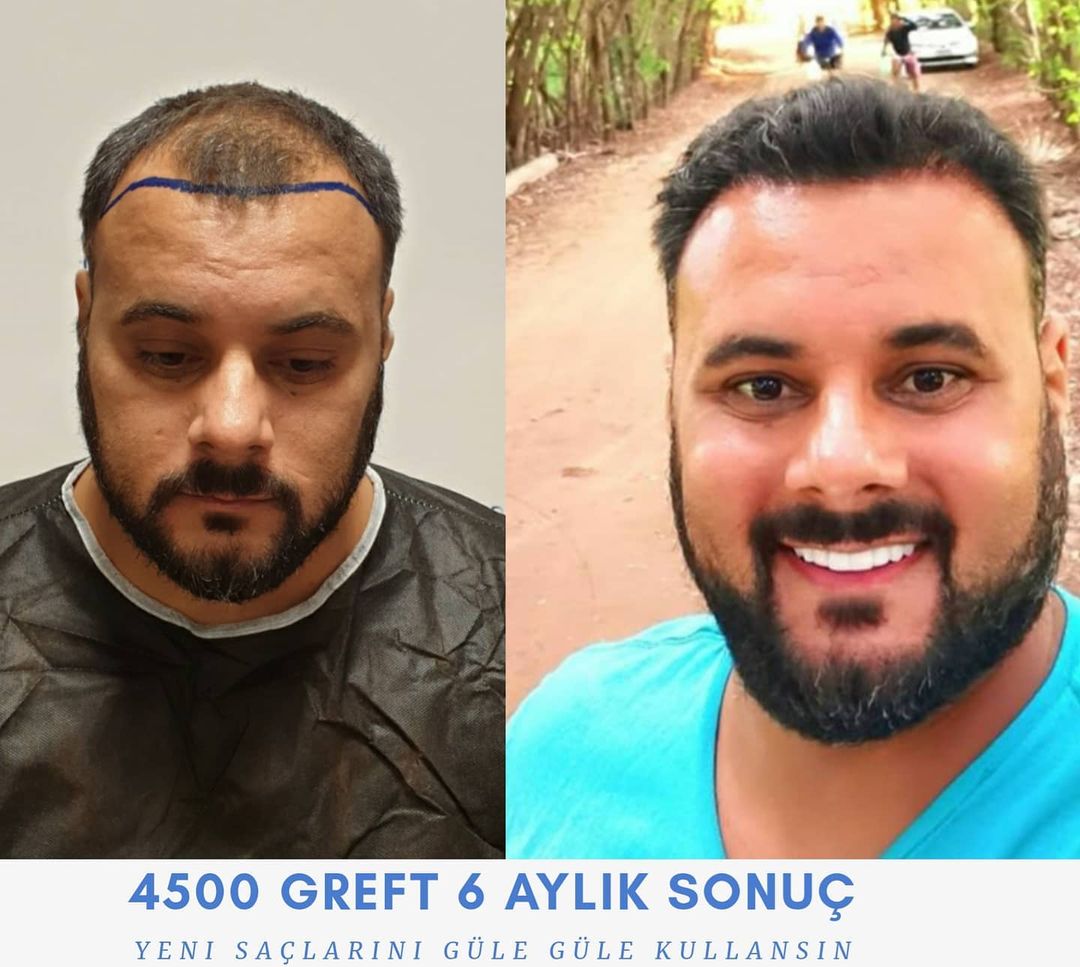 4500 GREFT 6 AYLIK SONUÇ
