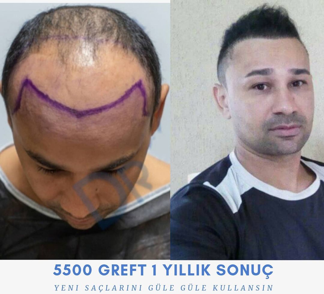 5500 GREFT 1 YLLIK SONUÇ