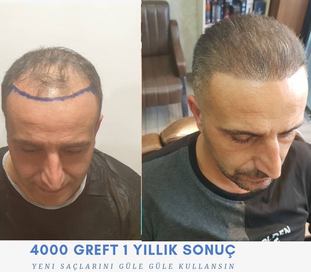 4000 GREFT 1 YLLIK SONUÇ