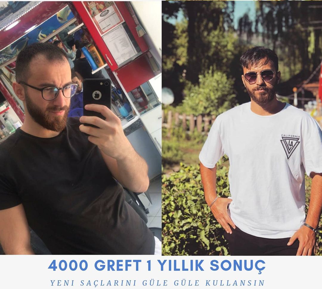 4000 GREFT 1 YLLIK SONUÇ