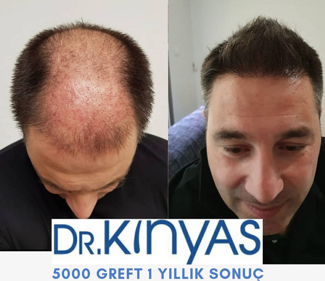 5000 GREFT 1 YLLIK SONUÇ