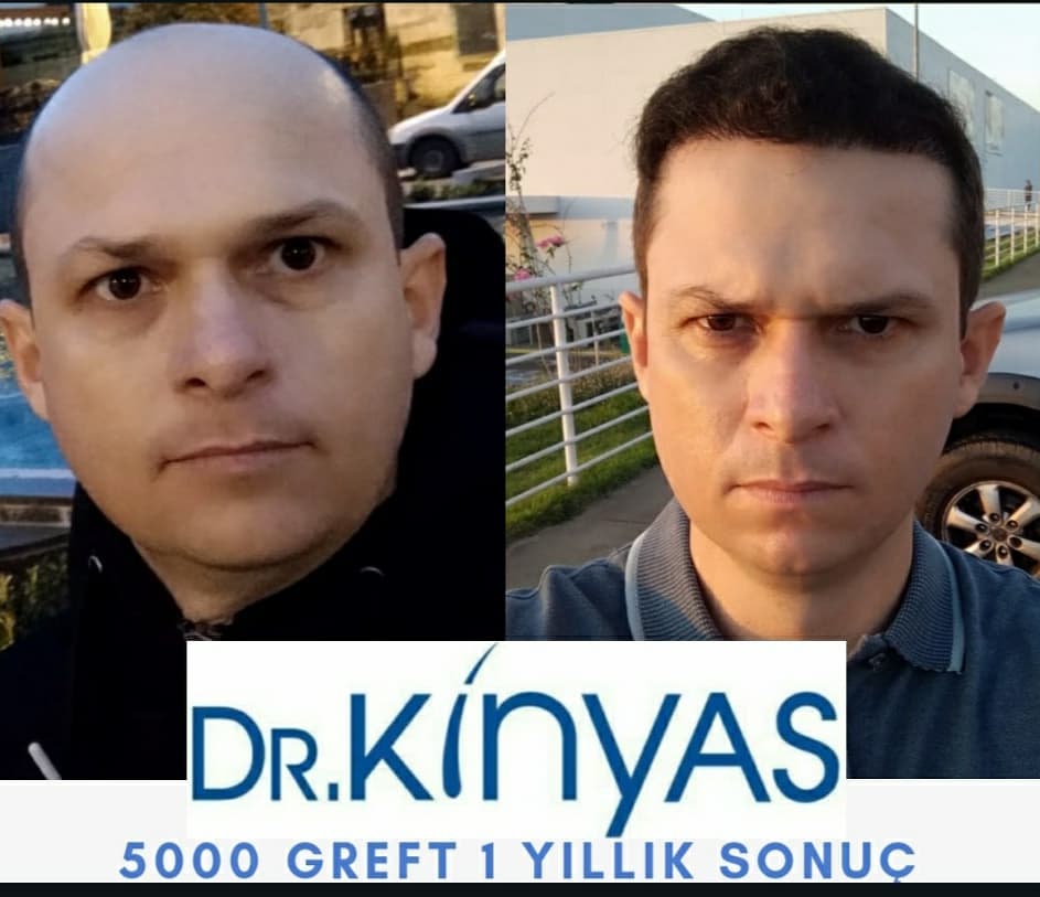 5000 GREFT 1 YLLIK SONUÇ