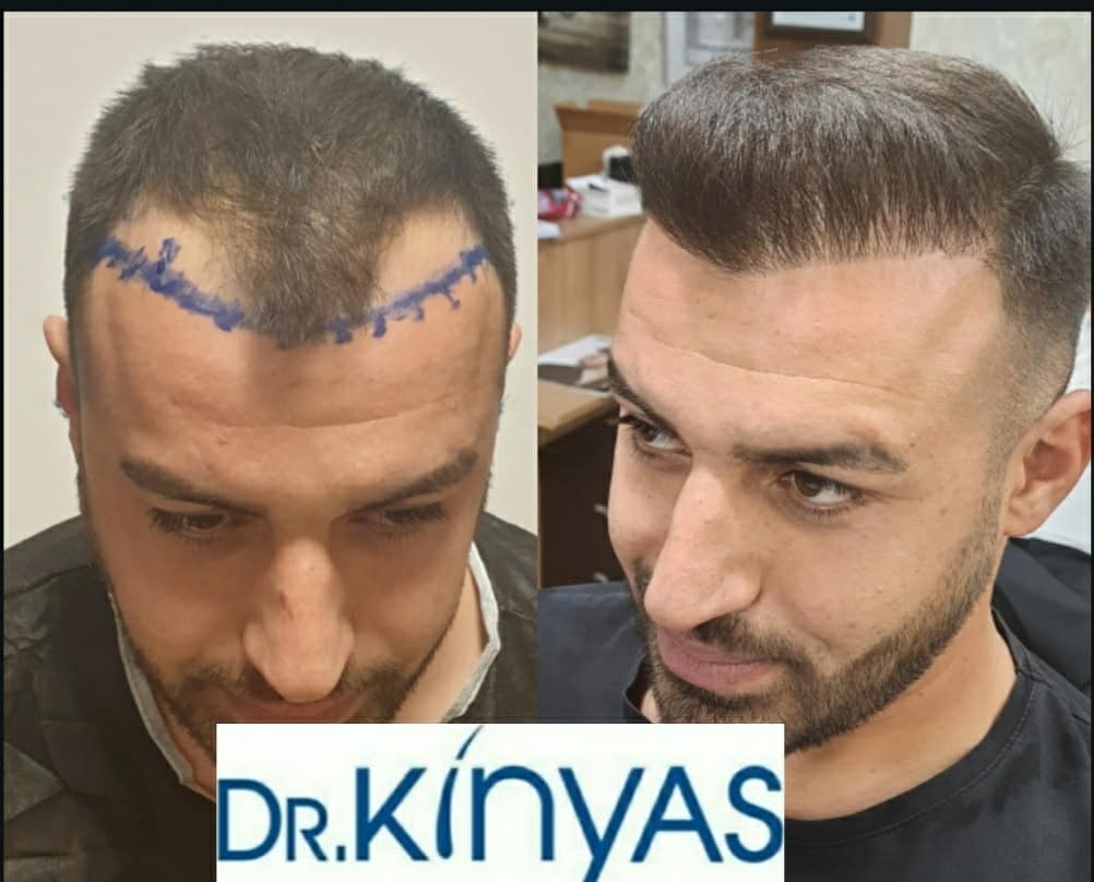 ÖNCESİ - SONRASI