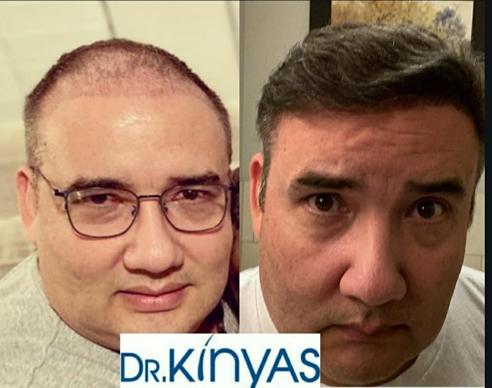 ÖNCESİ - SONRASI
