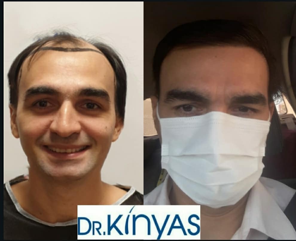ÖNCESİ - SONRASI
