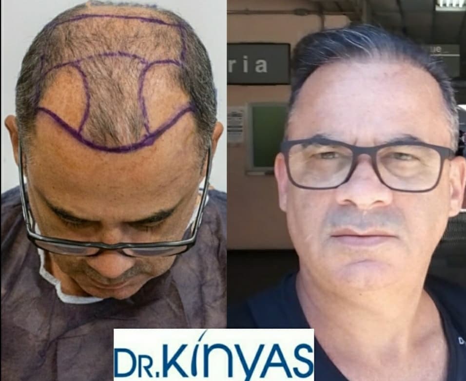 ÖNCESİ - SONRASI