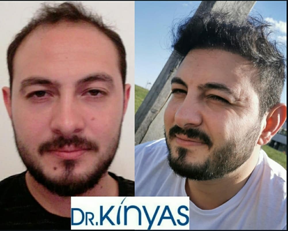 ÖNCESİ - SONRASI