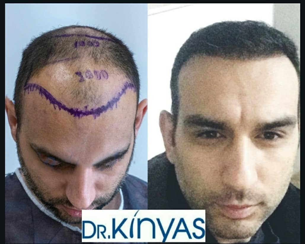 ÖNCESİ - SONRASI