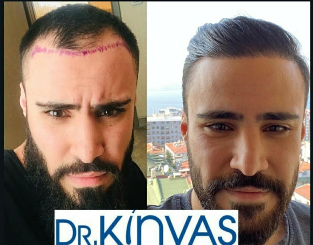 ÖNCESİ - SONRASI