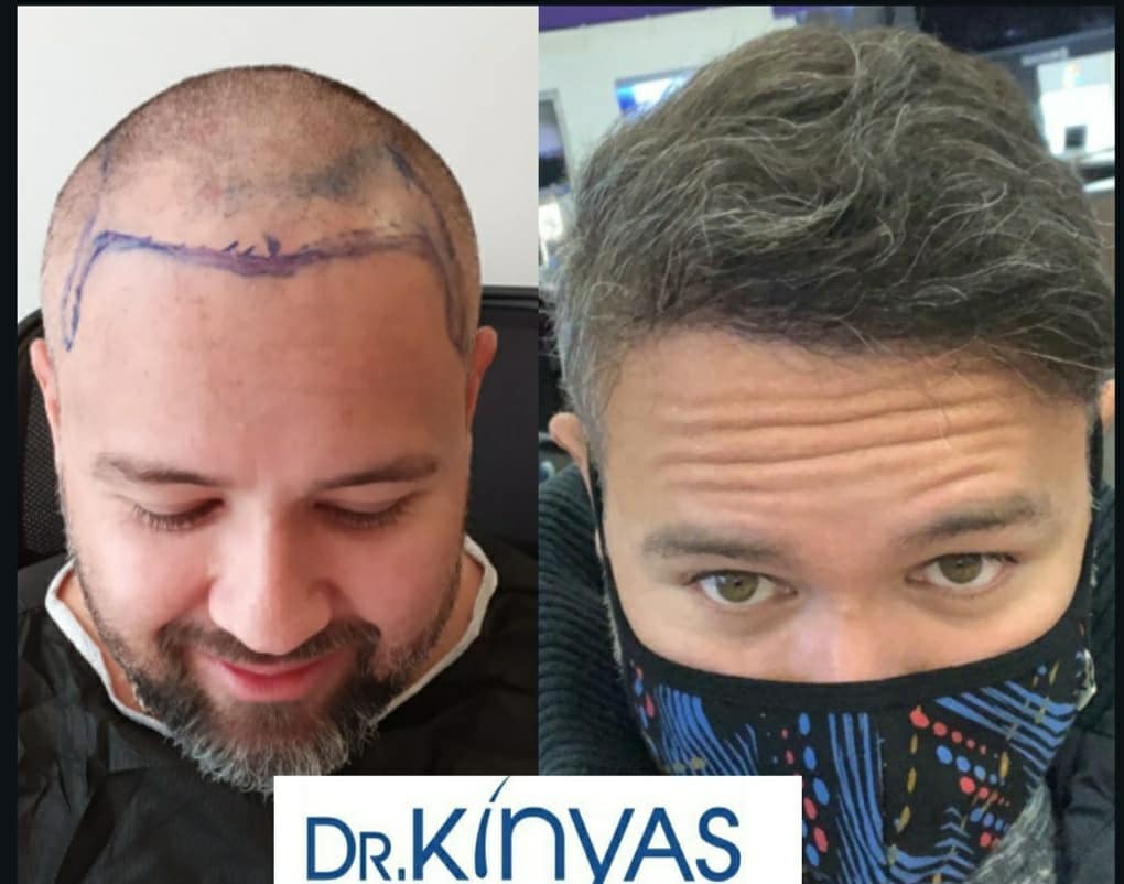 ÖNCESİ - SONRASI
