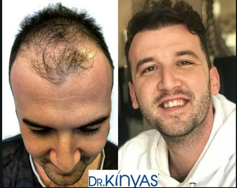 ÖNCESİ - SONRASI