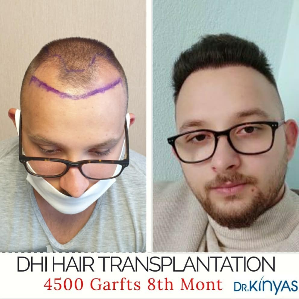 4500 GREFT 8 AYLIK SONUÇ