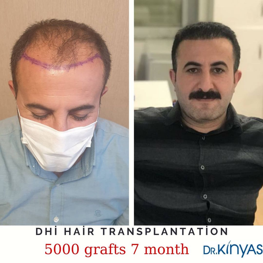 5000 GREFT 7 AYLIK SONUÇ
