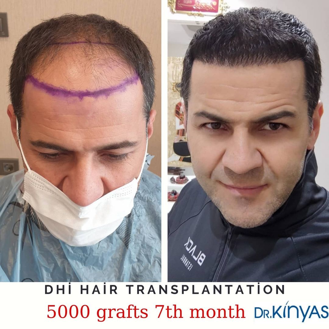 5000 GREFT 7 AYLIK SONUÇ