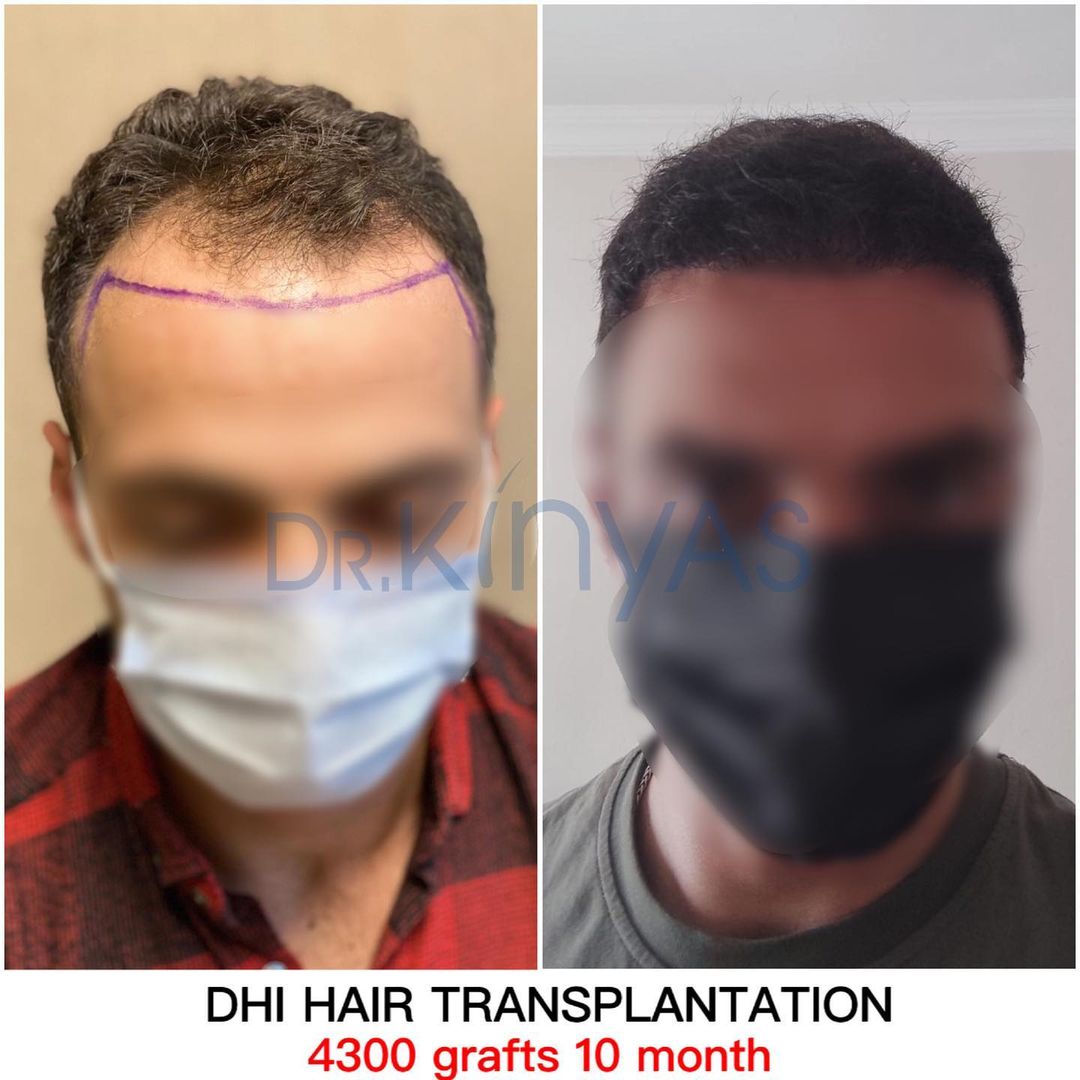 4300 GREFT 10 AYLIK SONUÇ
